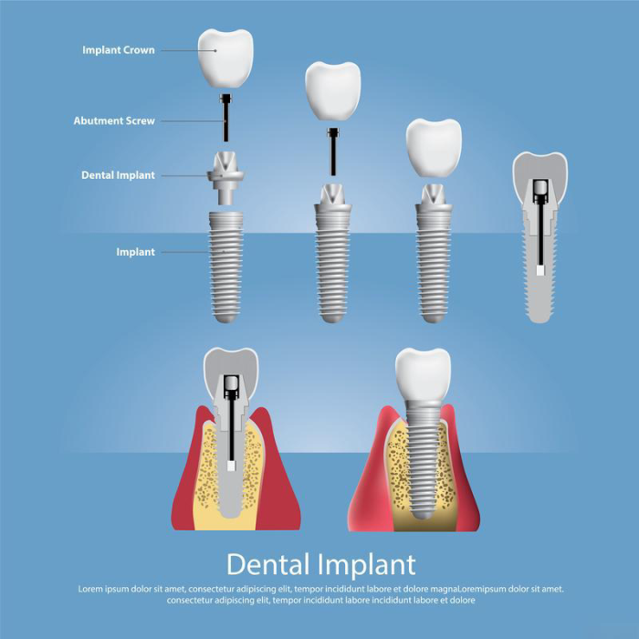 titanium alloys are used to make Dental implant